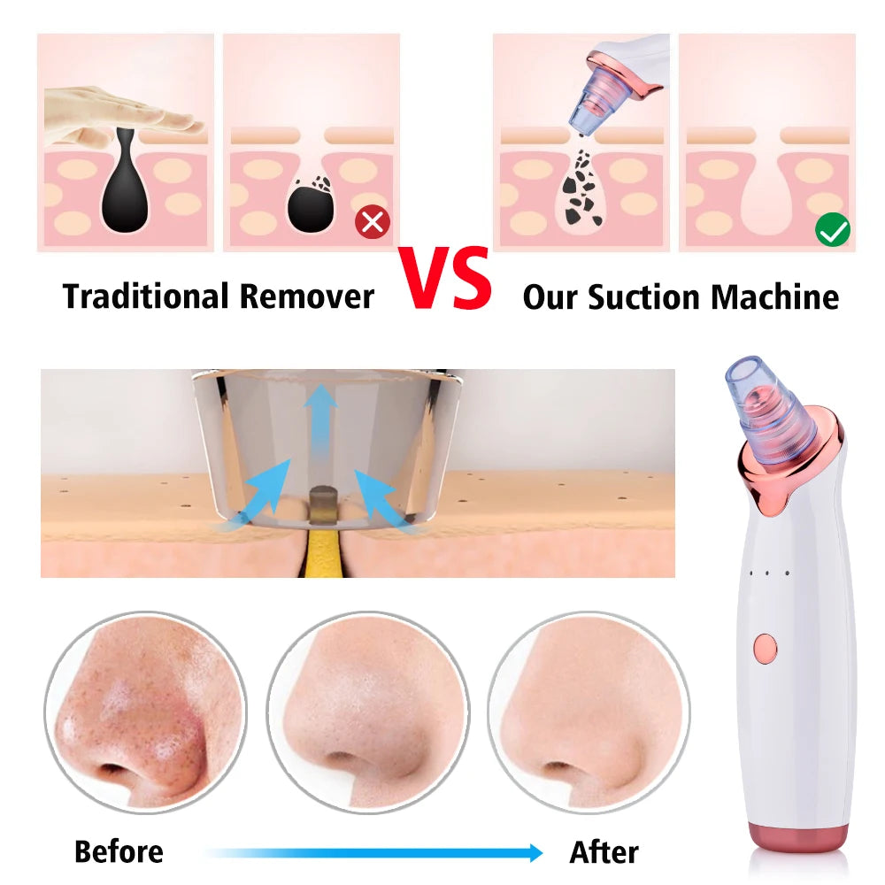 Vacuum Blackhead Removal Facial Cleansing Beauty Instrument, USB Charge Skincare Tool - Acne Pimple Remover, Black Spots Suction